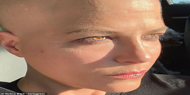 صورة بعد جلسات العلاج الكيميائي.. سلمى تظهر عارية