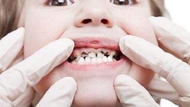 صورة أسباب تآكل الأسنان عند الأطفال وأعراضه وطرق الوقاية